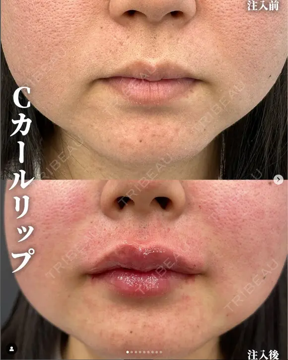 Cカールリップ（ボルベラ） after画像 メイン用