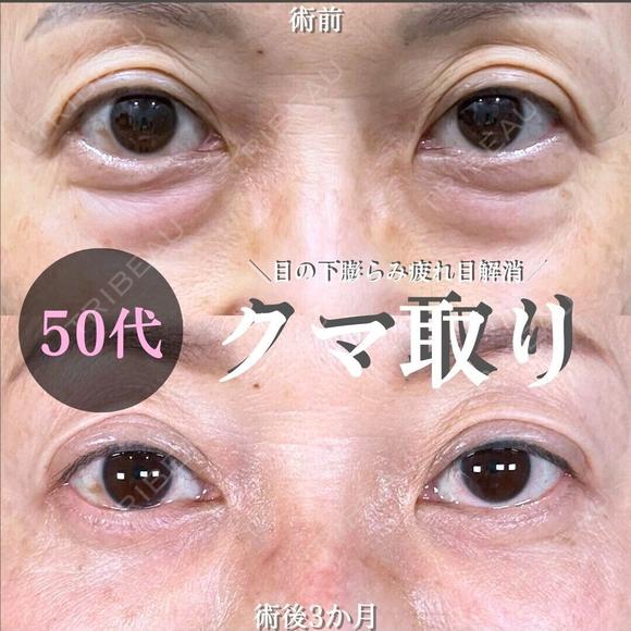 切らない目の下のクマ取り/余剰皮膚切除/脂肪注入（目の上・目の下・ゴルゴライン） 90日後 メイン用