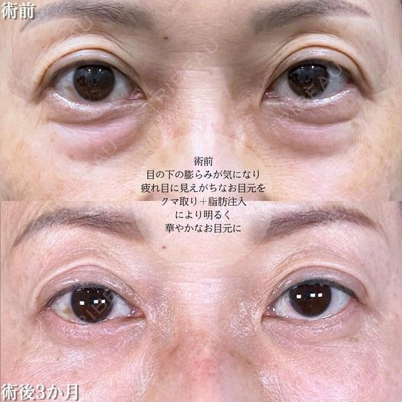切らない目の下のクマ取り/余剰皮膚切除/脂肪注入（目の上・目の下・ゴルゴライン） before画像 メイン用