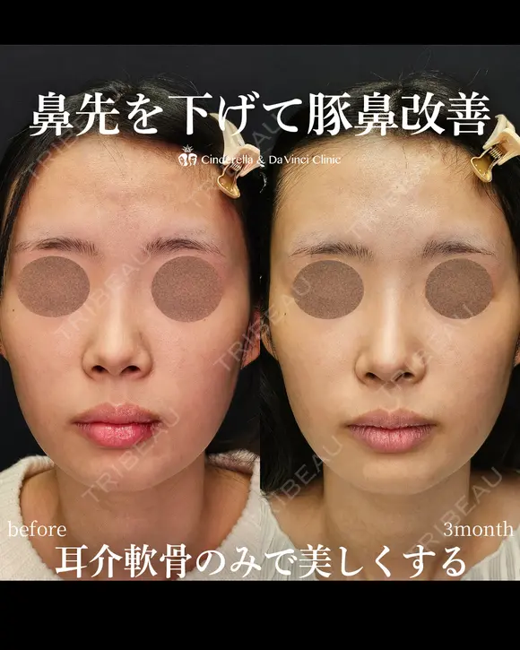 鼻先を下げて豚鼻改善 before画像 メイン用