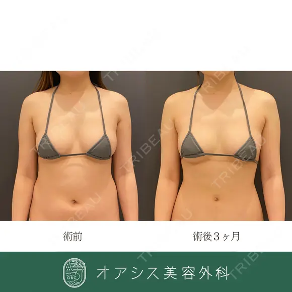 バストの輪郭をより綺麗に👙豊胸術（脂肪注入）＋コンプリート脂肪吸引（腹部全体） before画像 メイン用