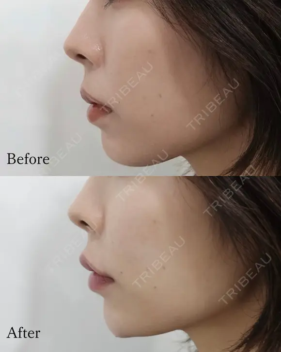 Eライン形成 before画像 メイン用
