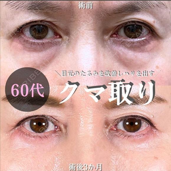 切らない目の下のクマ取り/余剰皮膚切除/脂肪注入（目の下・ゴルゴライン） 90日後 メイン用