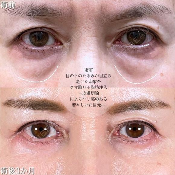 切らない目の下のクマ取り/余剰皮膚切除/脂肪注入（目の下・ゴルゴライン） before画像 メイン用
