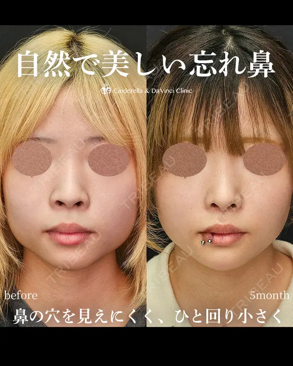 自然で美しい忘れ鼻 150日後 メイン用