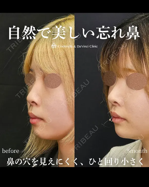 自然で美しい忘れ鼻 150日後 メイン用
