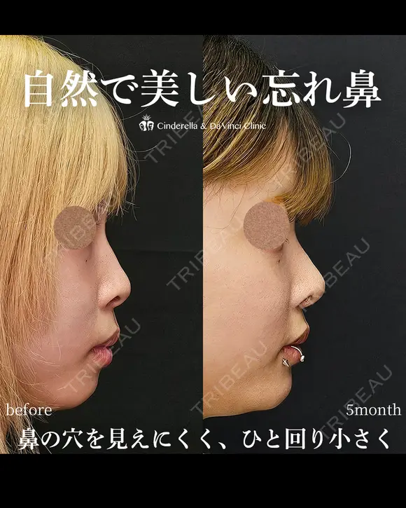 自然で美しい忘れ鼻 150日後 メイン用