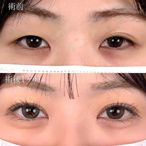 二重埋没法＋ まぶたの脂肪取り ＋目頭切開 before画像 メイン用
