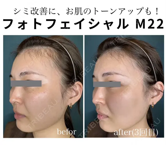 フォトフェイシャル M22・ステラM22（IPL） before画像 メイン用