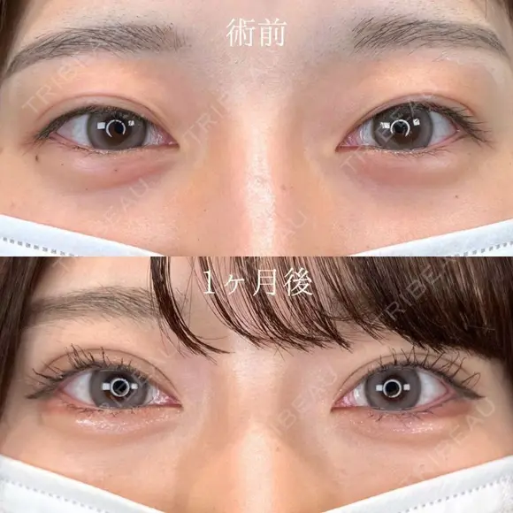 二重埋没法 ＋涙袋形成（ヒアルロン酸注射） after画像 メイン用