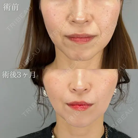小顔美肌再生（リフトアップ）＋ 各種ヒアルロン酸 before画像 メイン用