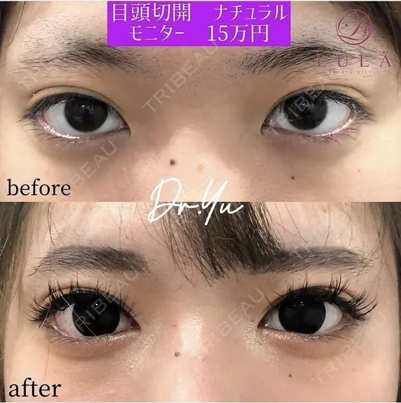 目頭切開 before画像 メイン用