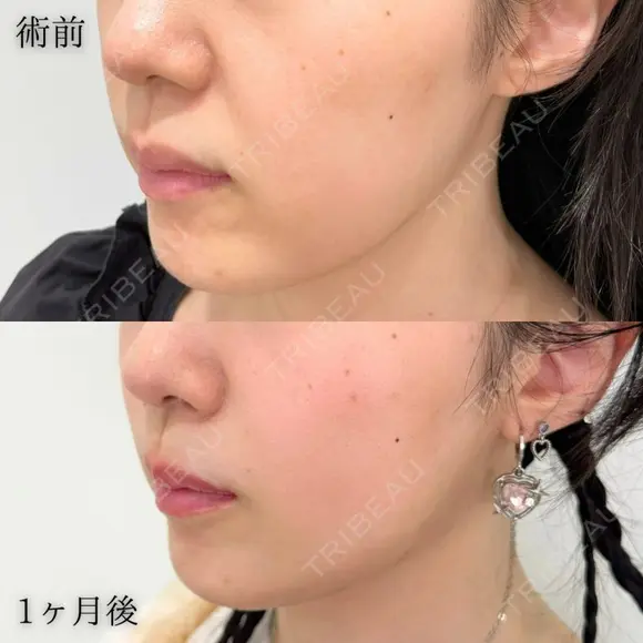 TCB小顔リフト＋ マリオネットライン（口元のしわ）ヒアルロン酸注射 ＋ゴルゴ線のヒアルロン酸注射＋ ほうれい線のヒアルロン酸注射 before画像 メイン用