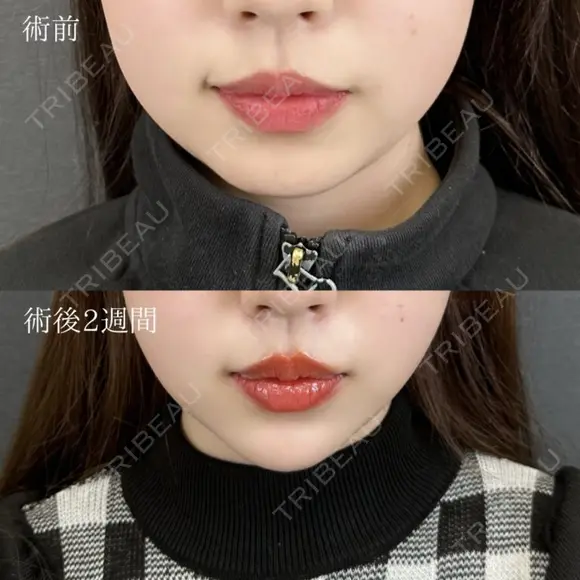 顔の脂肪吸引 +切らない顎形成 3D Eライン+ 顎（あご）のヒアルロン酸注射+ 小顔美肌再生（リフトアップ） after画像 メイン用