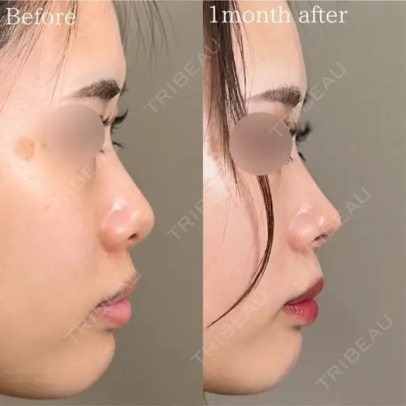 鼻尖形成 after画像 メイン用