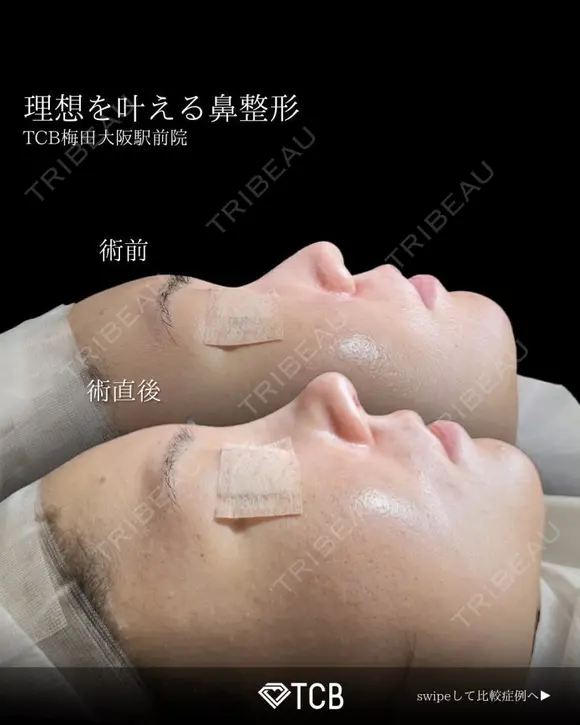 鼻尖形成＋鼻プロテーゼ（隆鼻術）＋鼻中隔延長術 after画像 メイン用
