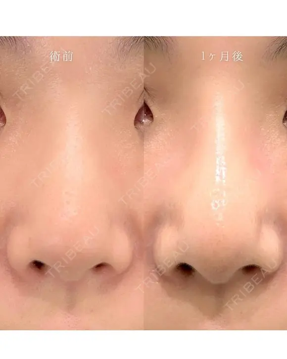鼻尖形成＋TCBメッシュ after画像 メイン用