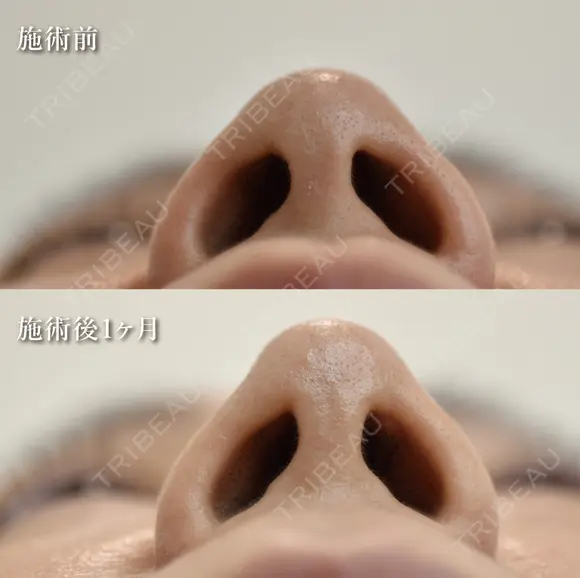 鼻尖形成＋切らない小鼻縮小（鼻翼縮小埋没法） after画像 メイン用