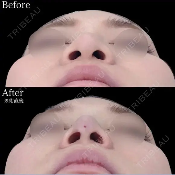 鼻尖形成＋TCBメッシュ before画像 メイン用