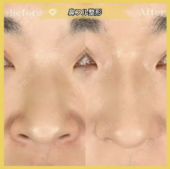 TCB式鼻翼縮小完全内側法・外側法＋鼻尖形成＋TCBメッシュ＋切らない鼻中隔延長＋小鼻縮小ボトックス注射 before画像 メイン用