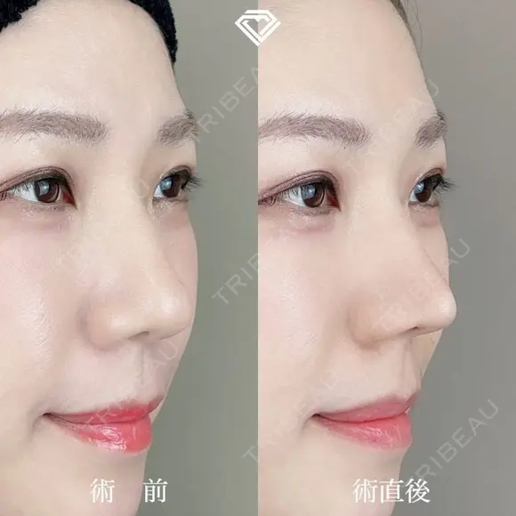 TCB式鼻先尖鋭術（だんご鼻解消） after画像 メイン用
