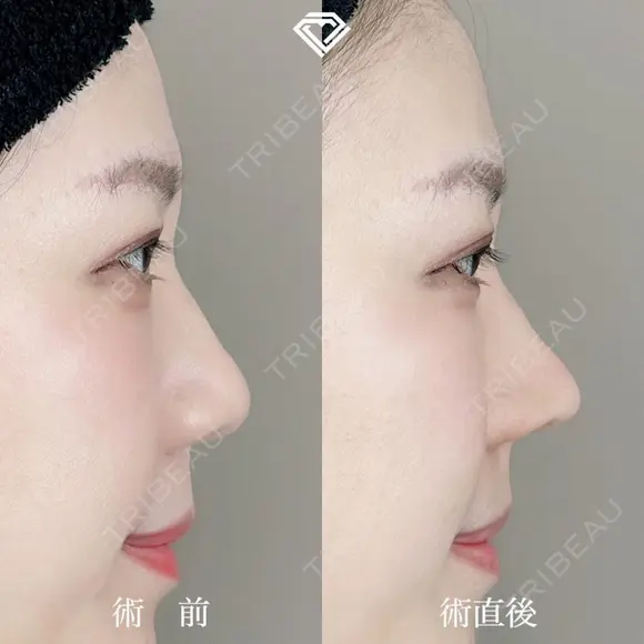 TCB式鼻先尖鋭術（だんご鼻解消） after画像 メイン用