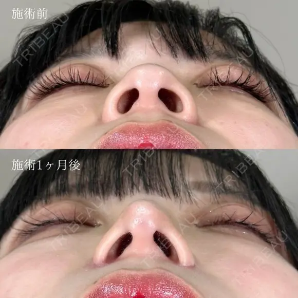 鼻尖形成＋TCB式鼻先尖鋭術（だんご鼻解消）＋TCBメッシュ＋小鼻縮小ボトックス注射 after画像 メイン用
