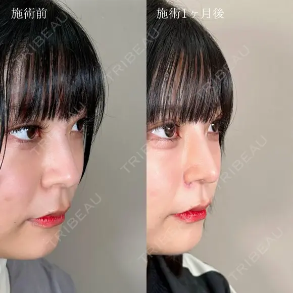 鼻尖形成＋TCB式鼻先尖鋭術（だんご鼻解消）＋TCBメッシュ＋小鼻縮小ボトックス注射 after画像 メイン用