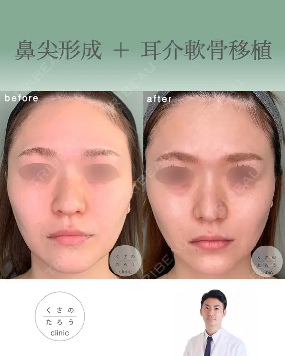 鼻尖形成+耳介軟骨移植 before画像 メイン用
