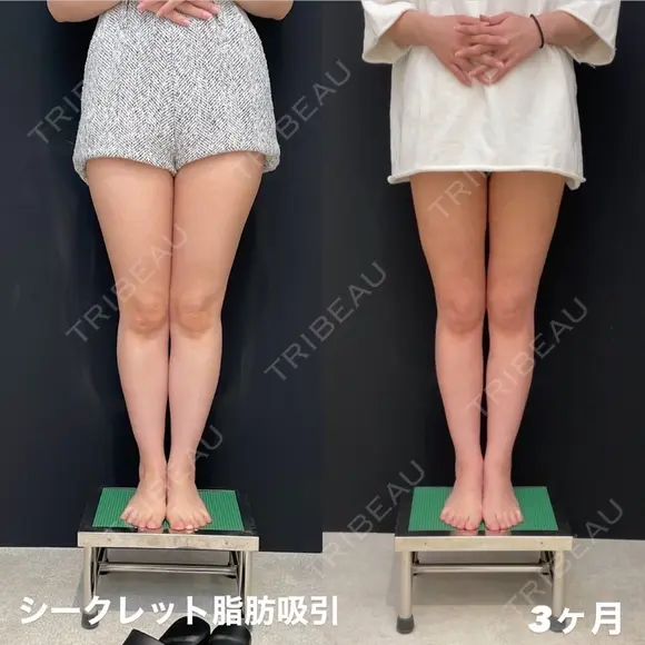 シークレット脂肪吸引太もも before画像 メイン用