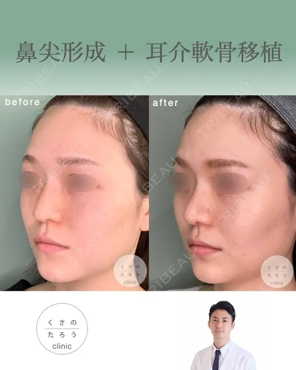 鼻尖形成+耳介軟骨移植 after画像 メイン用