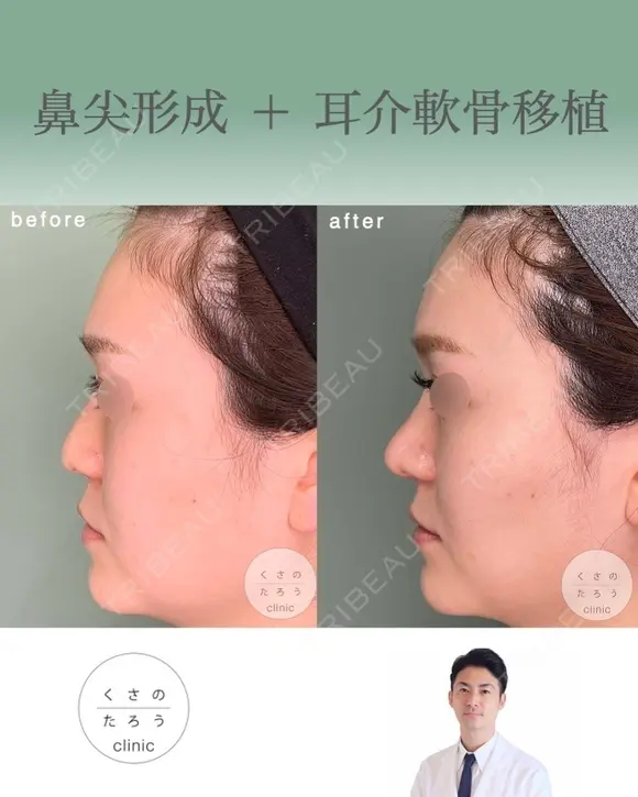 鼻尖形成+耳介軟骨移植 after画像 メイン用