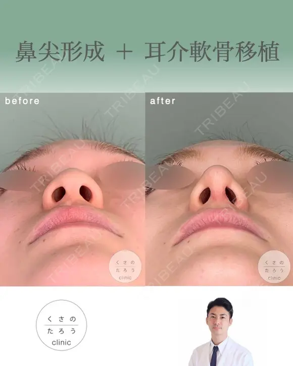 鼻尖形成+耳介軟骨移植 after画像 メイン用