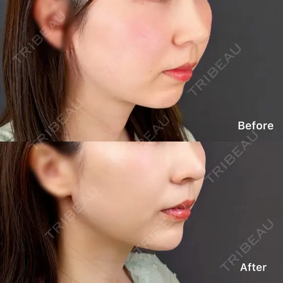 切らない顎形成 3D Eライン after画像 メイン用