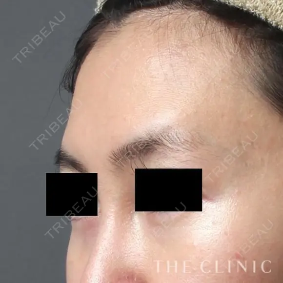 おでこの脂肪注入（CRF注入） before画像 メイン用