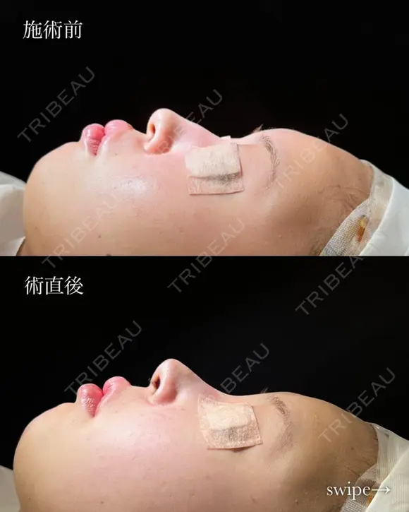 鼻プロテーゼ（隆鼻術）＋鼻尖形成＋鼻中隔延長術 after画像 メイン用