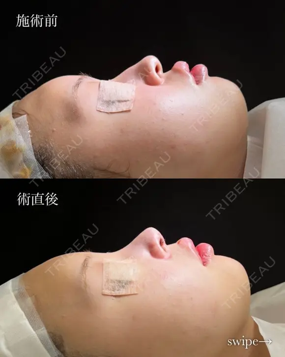 鼻プロテーゼ（隆鼻術）＋鼻尖形成＋鼻中隔延長術 after画像 メイン用