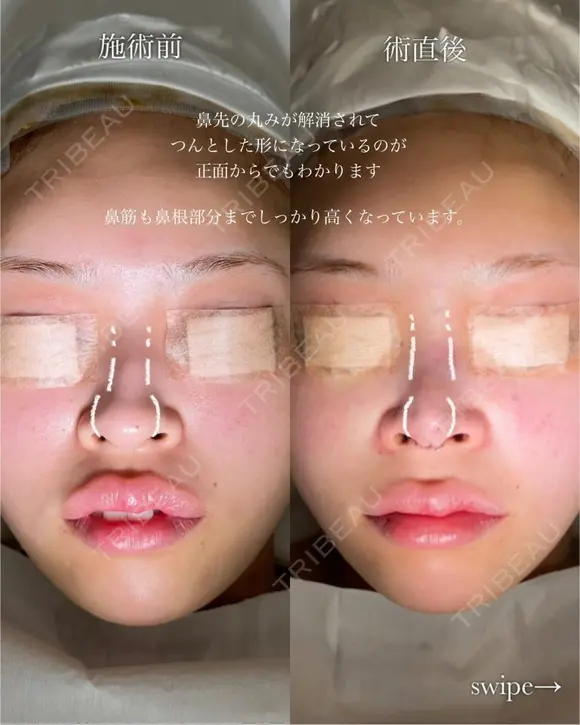 鼻プロテーゼ（隆鼻術）＋鼻尖形成＋鼻中隔延長術 after画像 メイン用
