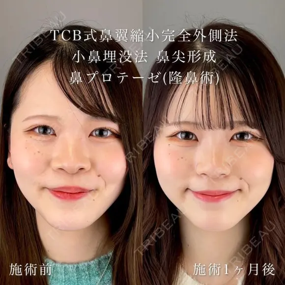 TCB式鼻翼縮小完全内側法・外側法＋鼻尖形成＋鼻プロテーゼ（隆鼻術）＋切らない小鼻縮小（鼻翼縮小埋没法） after画像 メイン用