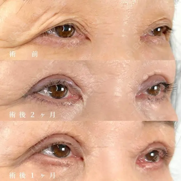 目の上のたるみ取り（上眼瞼除皺術） after画像 メイン用