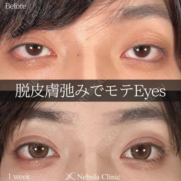 脱皮膚弛みでモテEyes👀✨ 6日後 メイン用