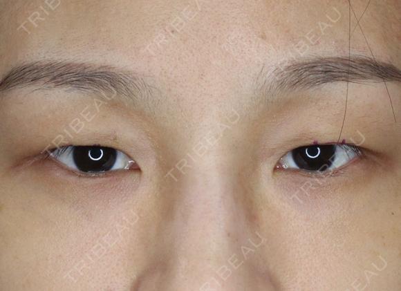 【20代女性・左右差をなくして綺麗な二重に】マイクロメソッド＋α（1ヶ月後） before画像 メイン用