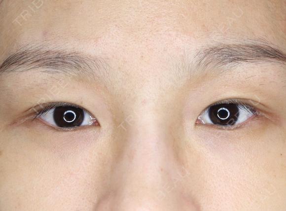 【20代女性・左右差をなくして綺麗な二重に】マイクロメソッド＋α（1ヶ月後） after画像 メイン用