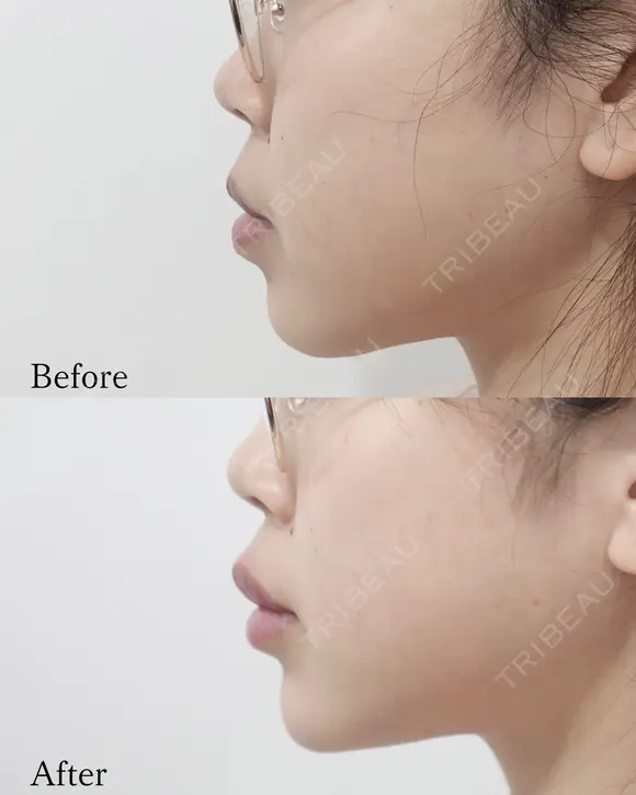 Eライン形成 before画像 メイン用
