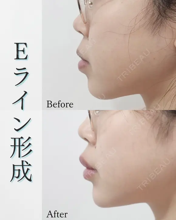 Eライン形成 after画像 メイン用