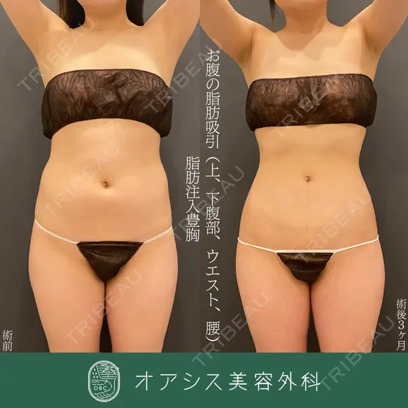 コンプリート脂肪吸引（上下腹部ウエスト腰）＋ラグジュアリー脂肪豊胸術💎遠心分離機で脂肪加工 before画像 メイン用