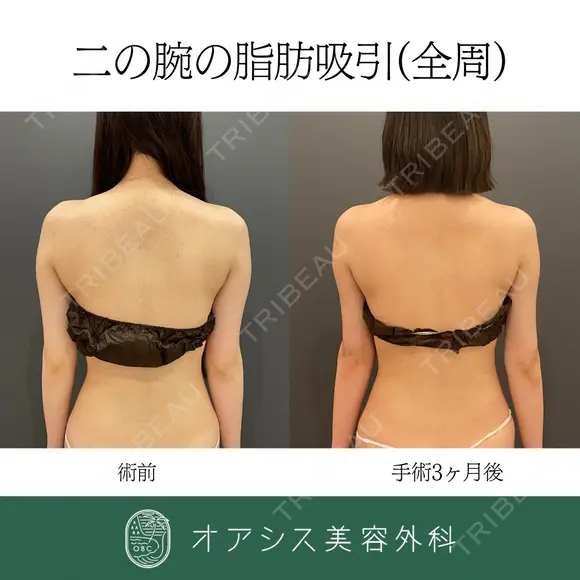 カリカリボディを目指す💉オアシスコンプリート脂肪吸引（上腕全周〜お背中一部）🌴 after画像 メイン用