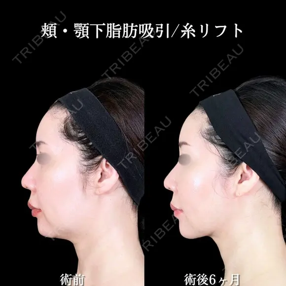 頬・顎下脂肪吸引/糸リフト before画像 メイン用