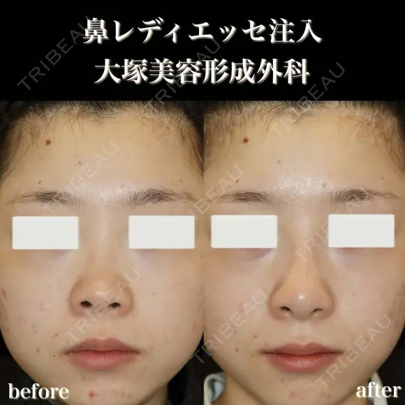 鼻レディエッセ注入 before画像 メイン用
