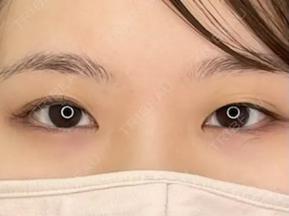 【二重埋没】自然癒着法 before画像 メイン用